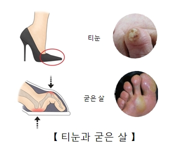 발 티눈의 원인, 제거방법, 예
