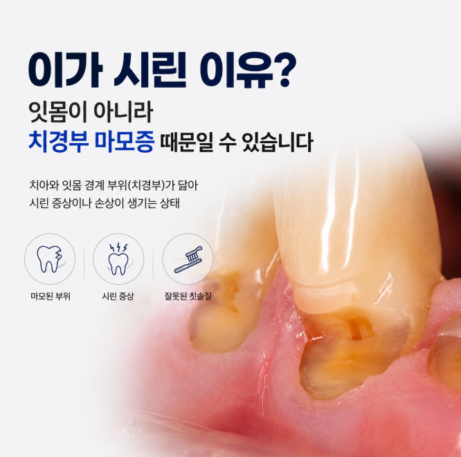 잇몸이 내려가서 이가 시려요 / 이가 시린 이유? 잇몸이 아니라 치경부 마모증 때문일 수 있....