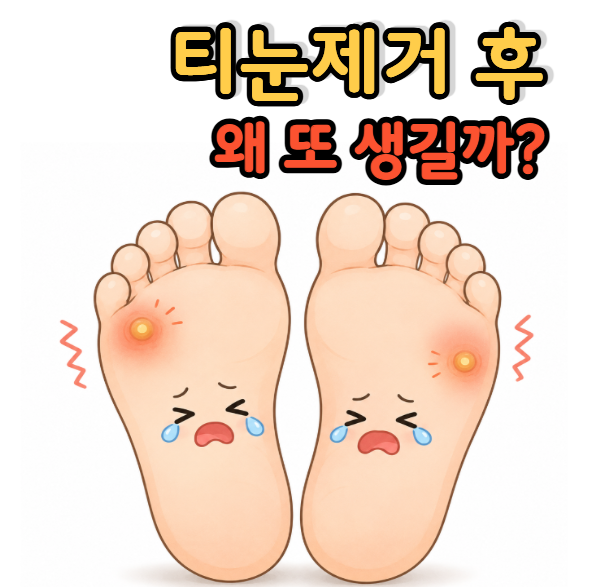 발건강 | 티눈 제거 후 다시 생기는 이유와 예방방법