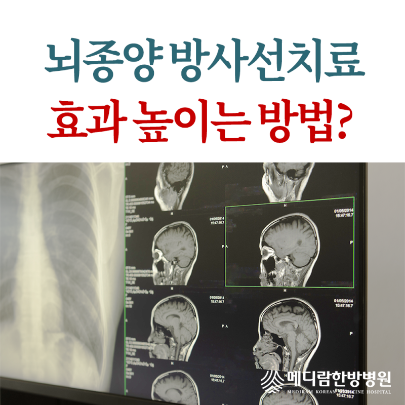 뇌종양 방사선치료 효과 높이는 방법