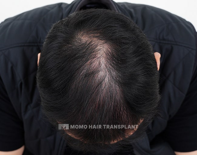 탈모예방, 의외로 많은 분들이 놓치는 시작 시점