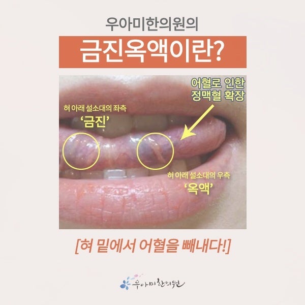 구강작열감증후군 병원, 혀 통증 약보다 원인을 찾는 과정이 필요합니다.