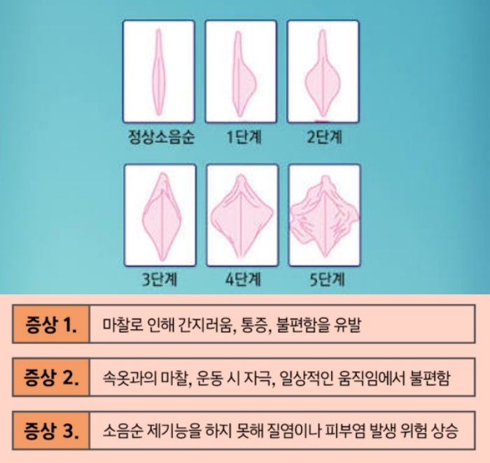 외음부 소양증, 질염 아니라는데 왜? (관리법 정리)