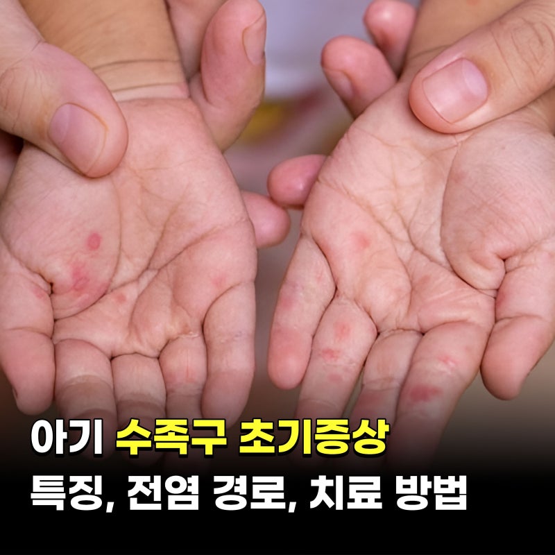 아기 수족구 초기증상 특징과 전염, 치료 방법