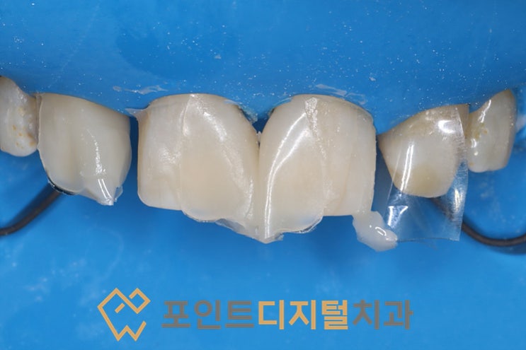 [탕정치과] 측절치 결손으로 인한 앞니 벌어짐(Diastema) 레진 재치료 feat. 바이오클리어 / 천안 아산