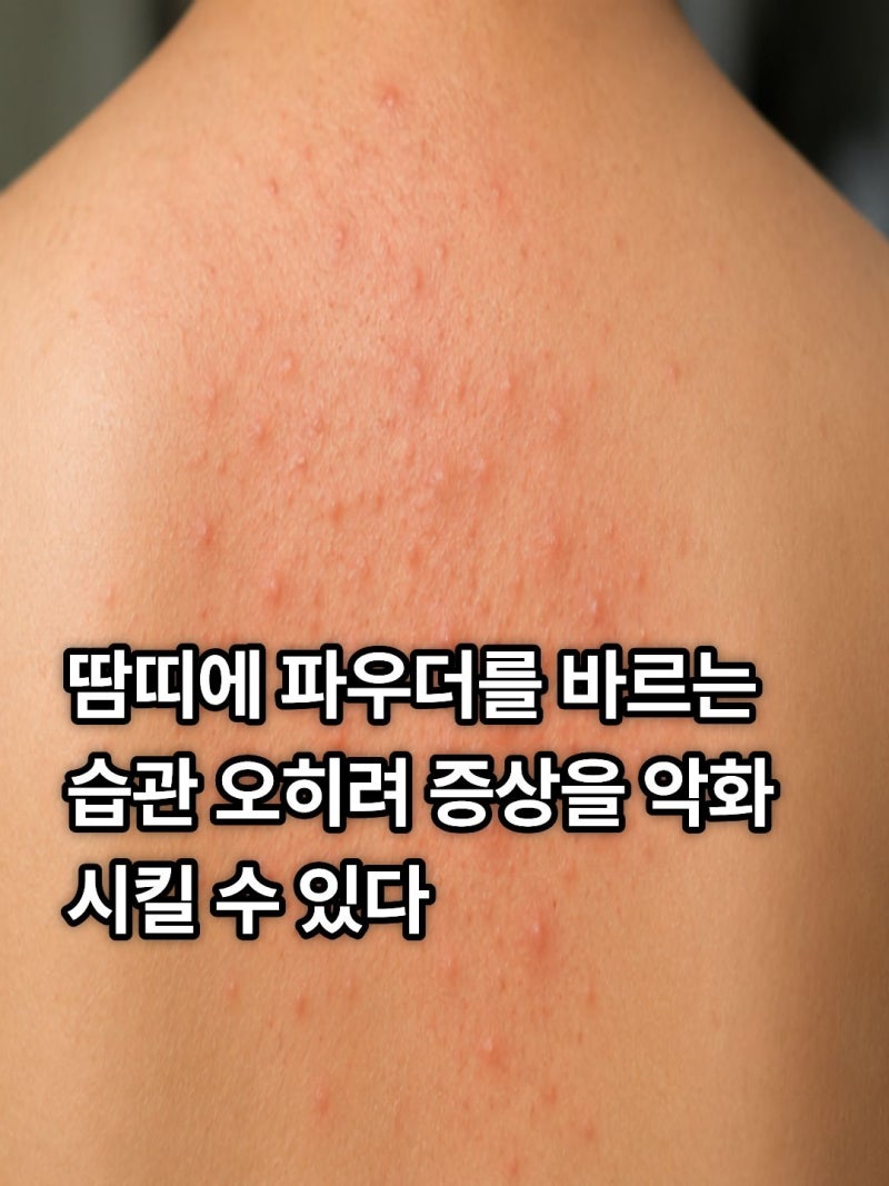 성인 땀띠 증상부터 연고·파우더 사용법까지! 빠르게 관리하는 방법 총정리