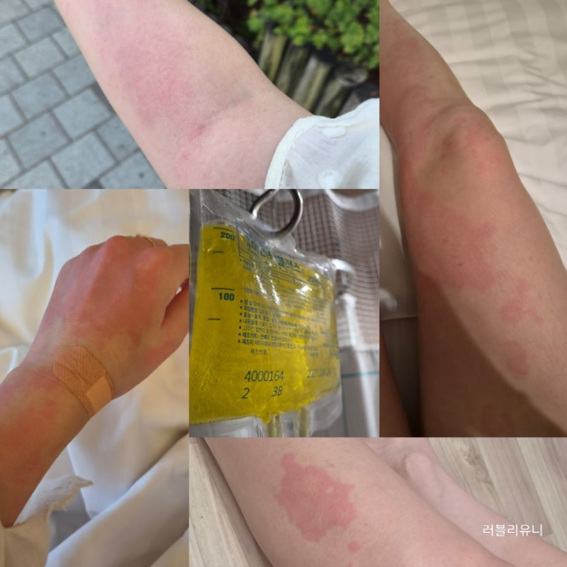 급성 두드러기 원인과 증상, 피부과 내과 모두 가본 일주일 후기