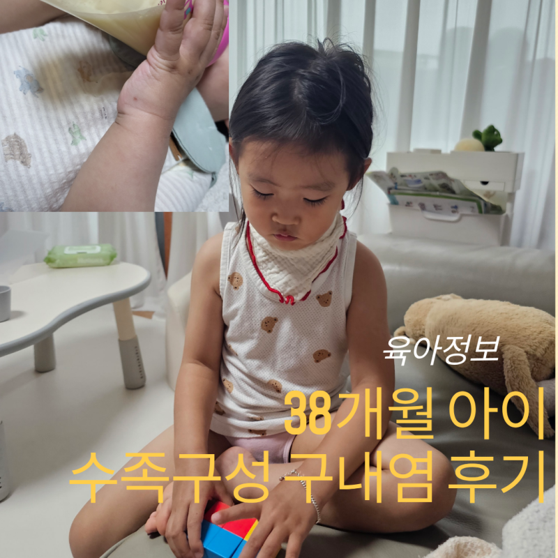 수족구 초기증상, 아기 구내염과 차이점 실제 경험 후기