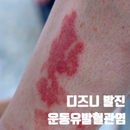 디즈니발진 운동유발혈관염, 갑자기 다리에 붉은 반점, 유사 질환
