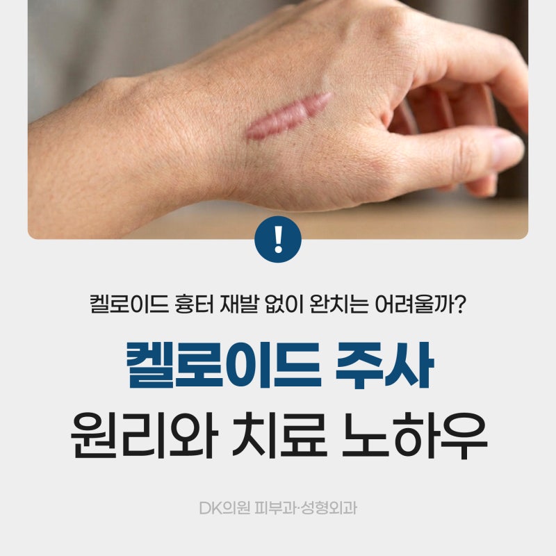 제왕절개·피어싱 켈로이드 주사, 재발 줄이는 보톡스 동시 시술 요법 ㅣ 강남 디케이의원