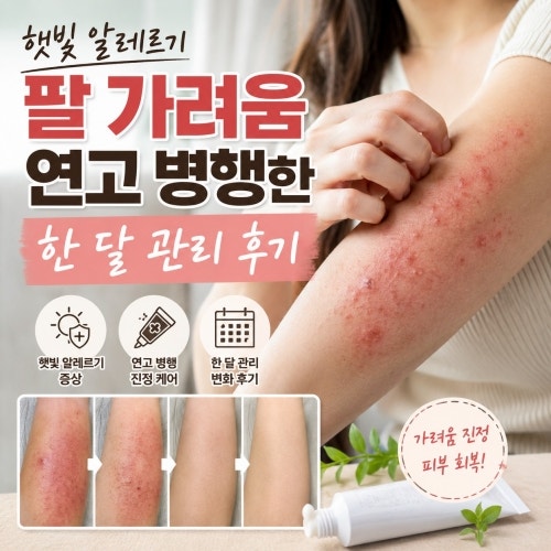 햇빛 알레르기 팔 가려움 연고 병행한 한 달 관리 후기