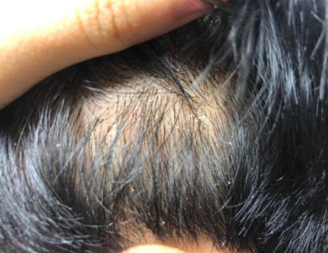 약국 니조랄 샴푸 잘못 쓰면 두피 더 망가집니다 (사용법 주의)