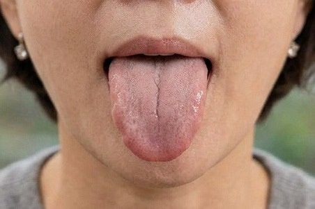 혀가 보내는 위험 신호…이 색과 모양이면 병원을 가야 합니다