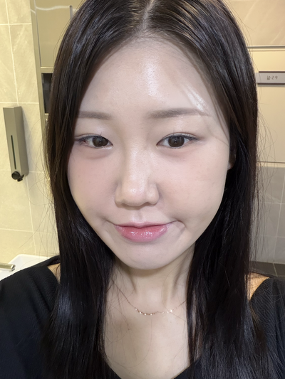 볼패임 시술로 유명한 콜라겐부스터 쥬베룩볼륨 가격, 부작용 등 솔직 후기