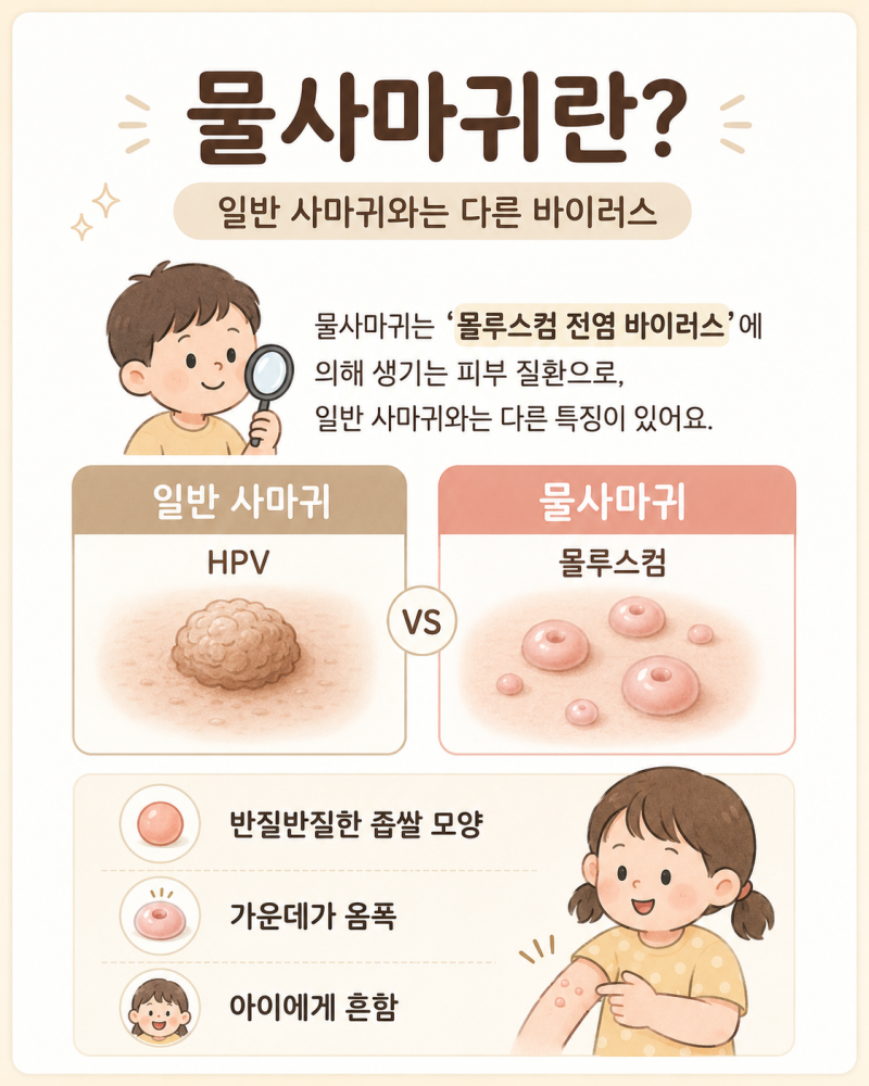 물사마귀, 아이한테 왜 잘 생기나요? | 원인·전염·자연경과