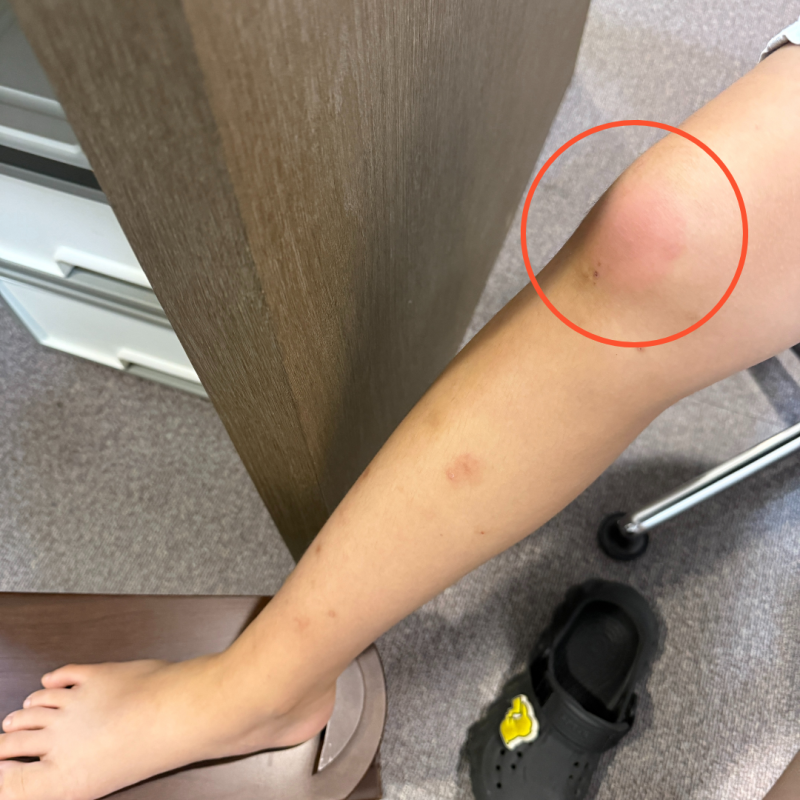 하안동정형외과 무릎 열감 통증 지속된다면? '점액낭염'
