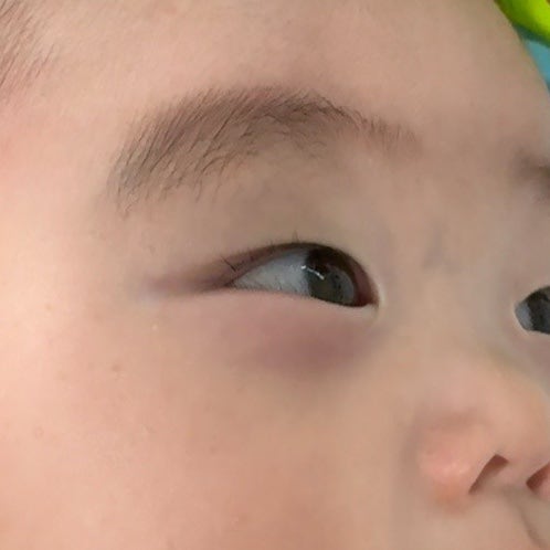 아기 눈다래끼 / 아기 콩다래끼 안과진료 / 아기 다래끼 항생제