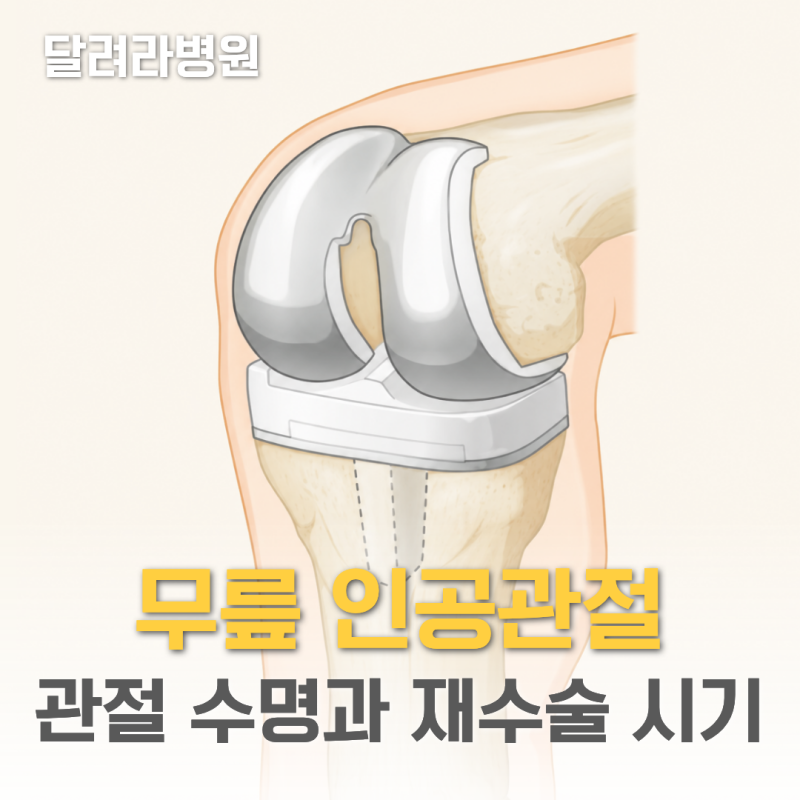 무릎인공관절 수명은 몇 년? 재수술을 받아야 하는 때는?