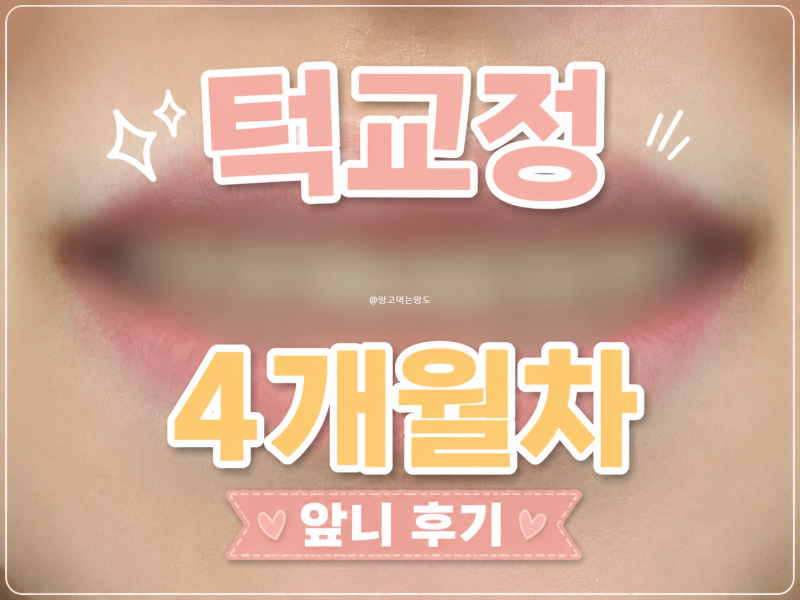 턱교정 4달차 후기｜주걱턱·안면비대칭 교정 앞니 변화 솔직 후기
