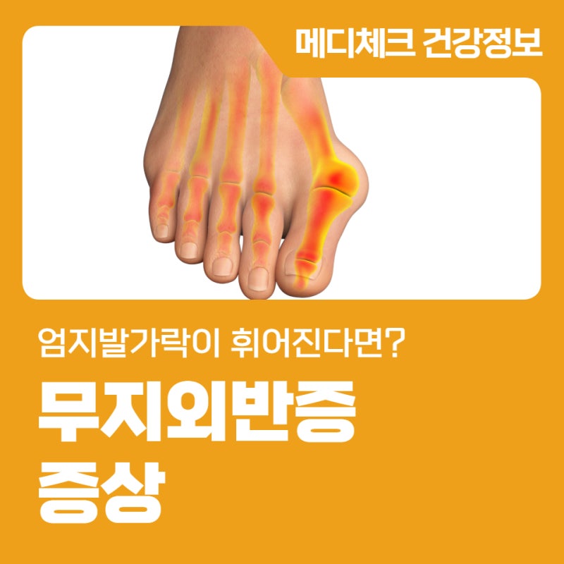 엄지발가락이 휘어진다면? 무지외반증 증상