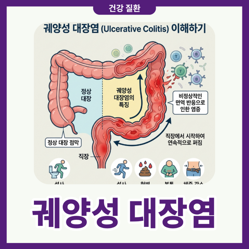 궤양성 대장염 증상 원인 무엇이 다를까? 치료방법까지 알아보기
