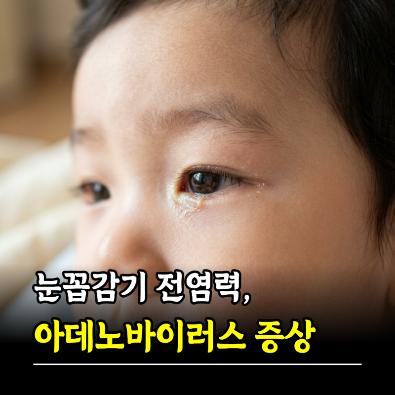 눈꼽감기 전염력, 아데노바이러스 증상 치료법