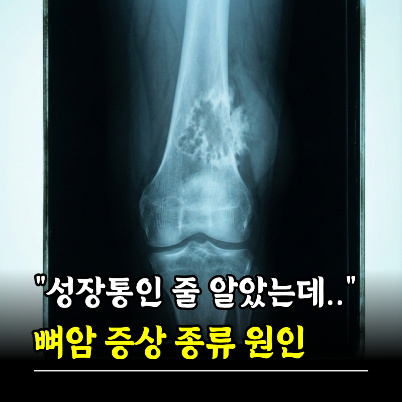 "성장통인 줄 알았는데.." 뼈암 증상 종류 원인