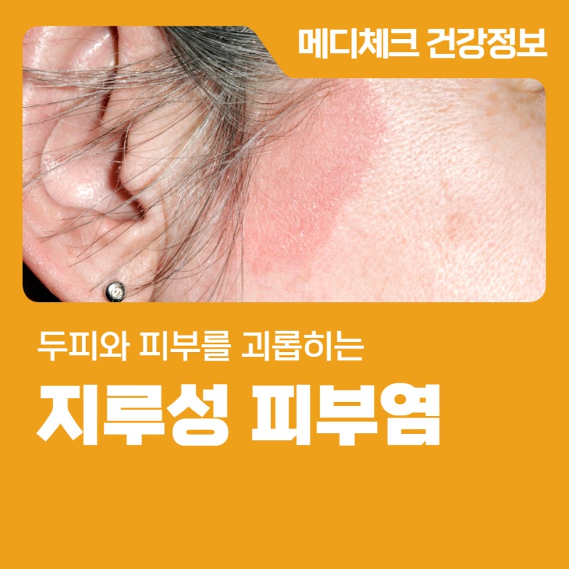 두피와 피부를 괴롭히는 지루성 피부염 알아보기