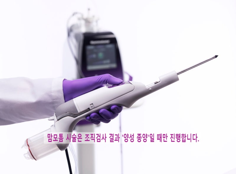 유방 결절, 맘모톰 시술이 꼭 필요한 경우는 언제일까요? 맘모톰 시술을 위한 필수 조건: '양....