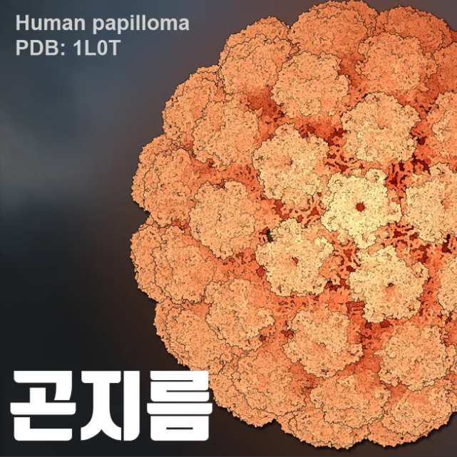 곤지름 콘딜로마, 생식기사마귀 원인 증상 치료, 알다라 크림 사용법