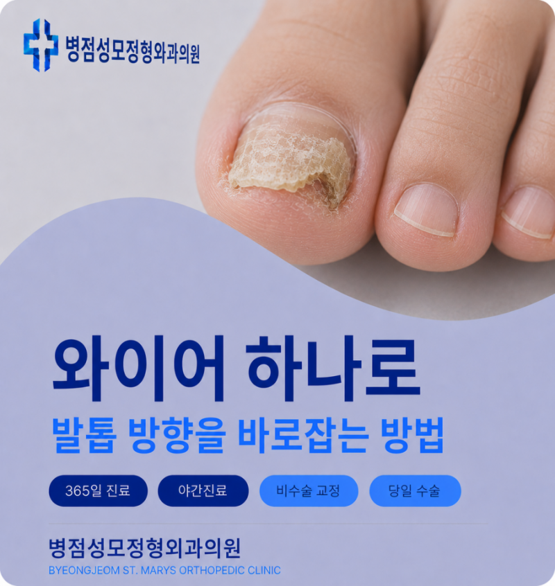 동탄발톱치료 와이어 하나로 발톱 방향을 바로잡는 방법