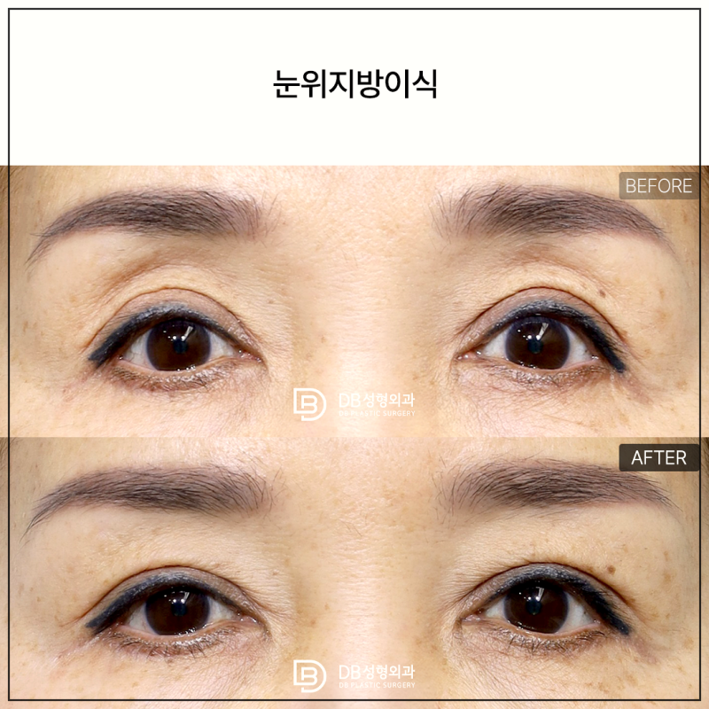 중년눈성형비용, 왜 사람마다 다를까요? 상안검·눈썹하거상·하안검 선택 기준｜디비성형외....