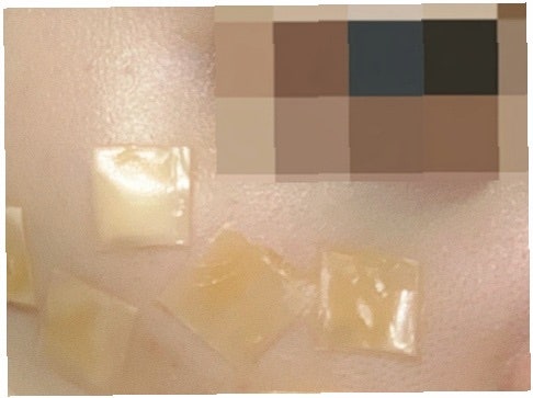 점 빼고 난 후 관리 술 운동 듀오덤 사용 총정리