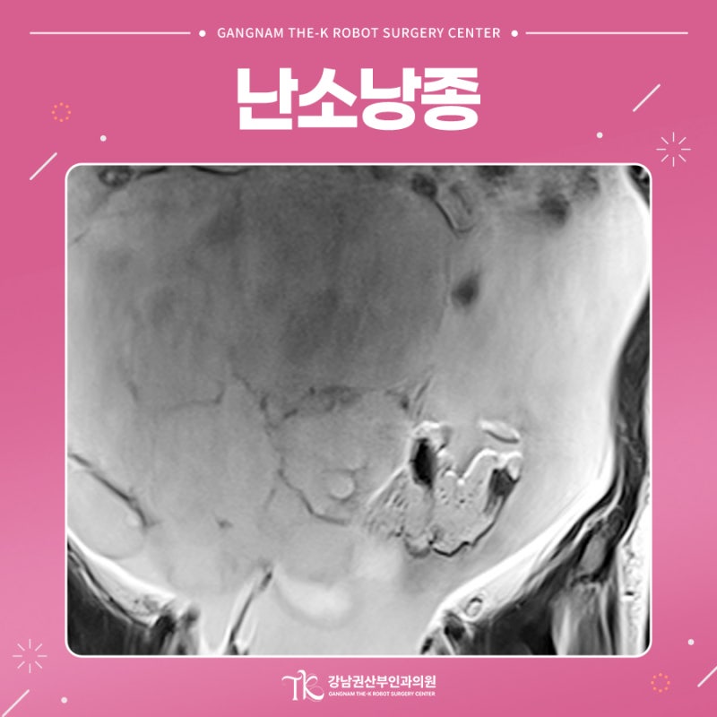 난소낭종 치료가 필요한 경우는 언제일까요?