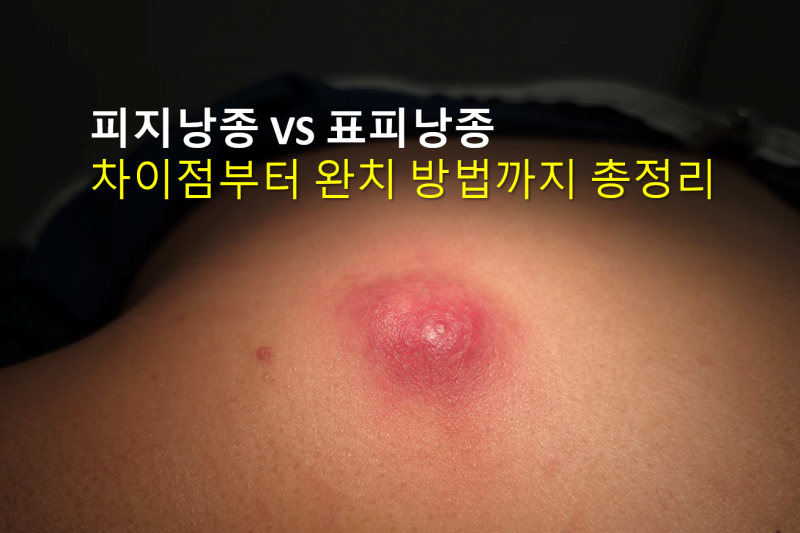 피지낭종 표피낭종 차이점 헷갈리지 마세요 모두 동일합니다