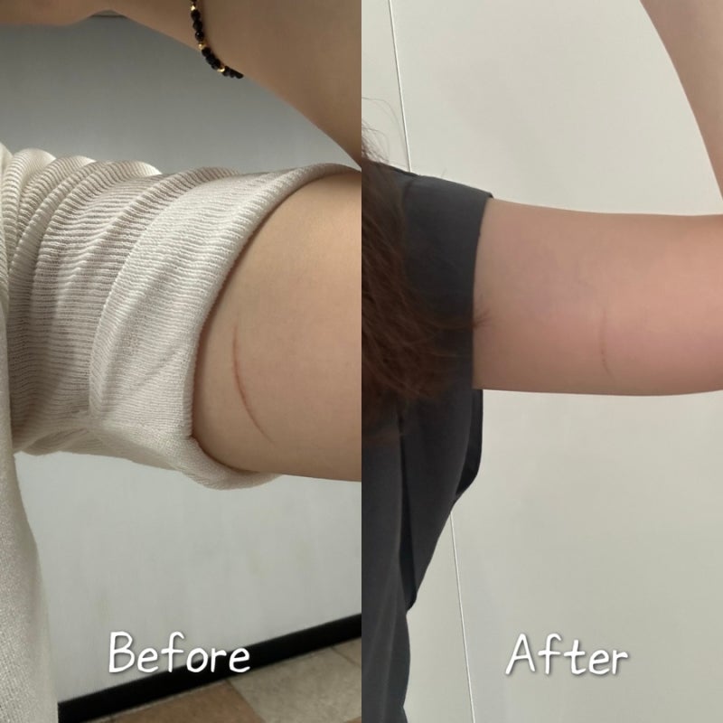 다리미에 데인 화상, 약사 추천 화상연고 '미보연고' 3주 후기