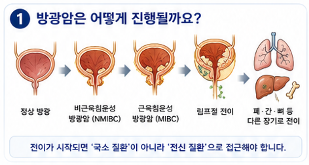 키트루다는 왜 방광암 치료의 역사를 바꾸었을까요?전이성 요로상피암에도 새로운 치료의 ....