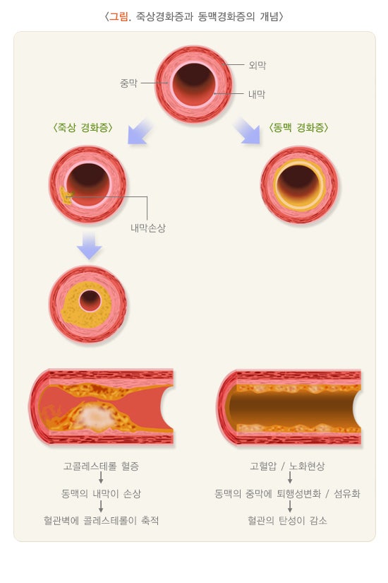 동맥경화, 증상이 없어서 더 위험합니다! 죽상경화증 제대로 알아보기