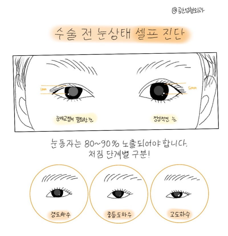 안검하수 교정 같은 졸린눈이라도 교정 방법은 다릅니다. (실제 눈 수술 사례)