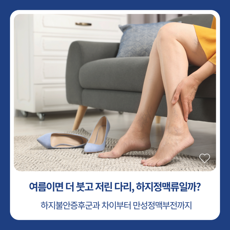 하지정맥류 증상, 하지불안증후군과의 차이부터 만성정맥부전까지 | 응암역 외과