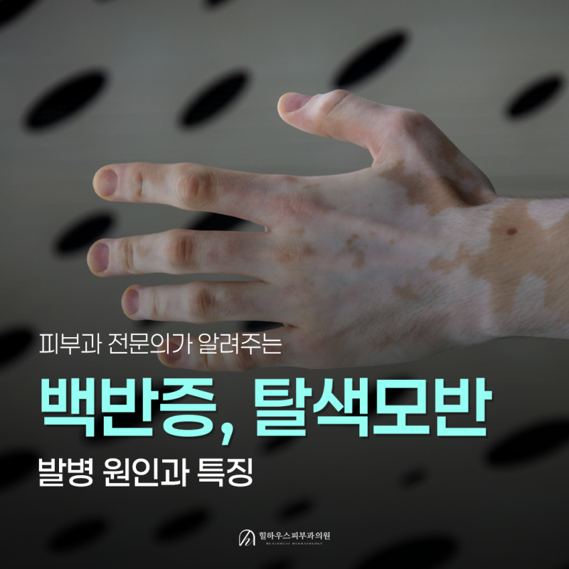 수원 피부과 피부에 하얀 반점이 생겼다면? 백반증과 탈색모반 차이, 원인부터 치료까지