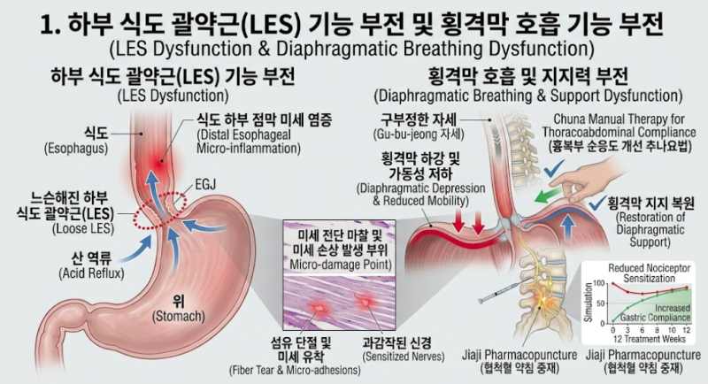 [안산 생명마루한의원] 목에 가래가 걸린 듯 답답하고 가슴이 쓰리다면? — 역류성 식도염의 ....