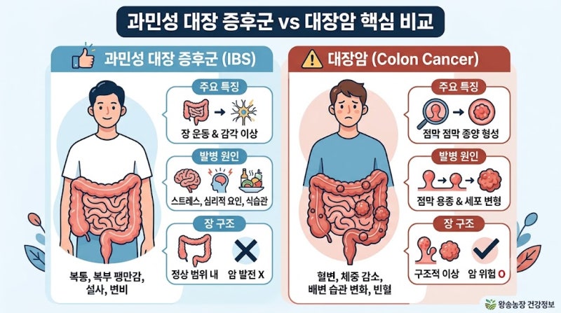 과민성 대장 증후군, 놔두면 대장암 될까? 10년 추적 관찰이 밝혀낸 뜻밖의 진실