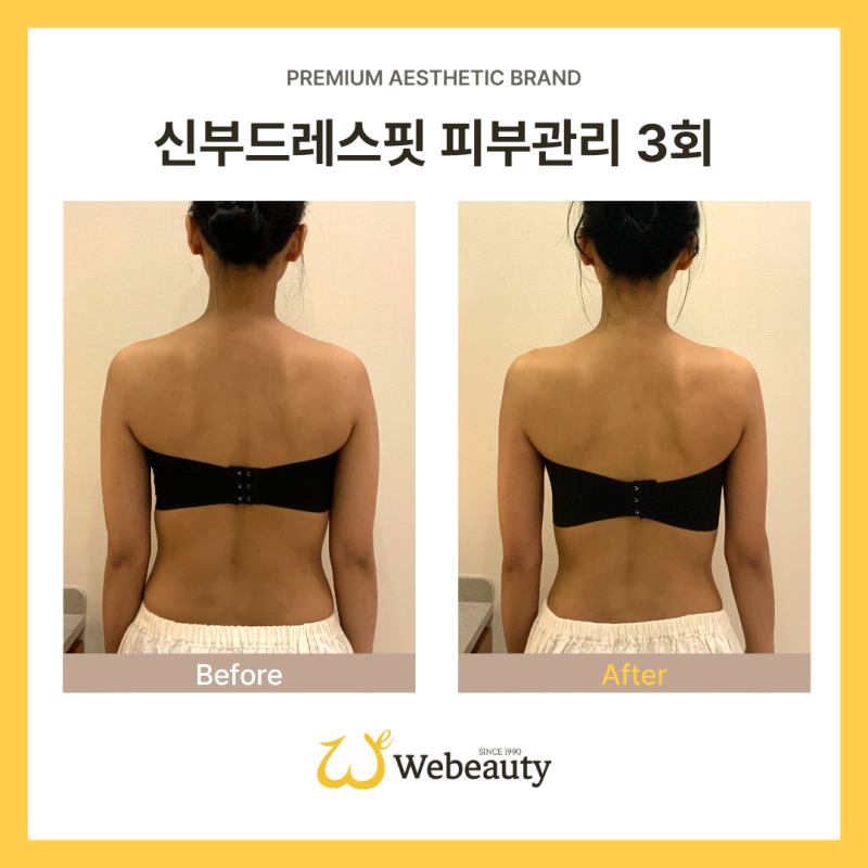 흉통벌어짐? 지금 바로 흉통줄이기 가능합니다.