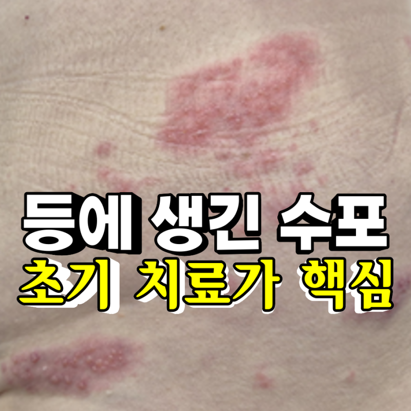 등 찌릿한 느낌 따끔거림 반복된다면 대상포진 초기증상 의심 바로 병원으로