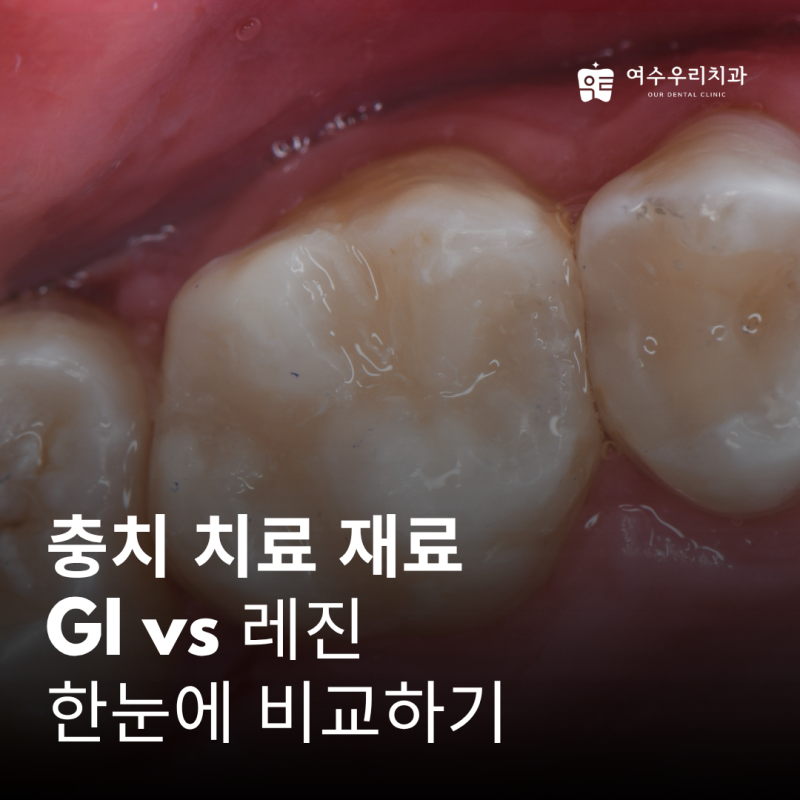 여수치과 ｜ 여수 충치 치료, GI vs 레진 고민이라면? 치과의사가 쉽게 정리해 드립니다