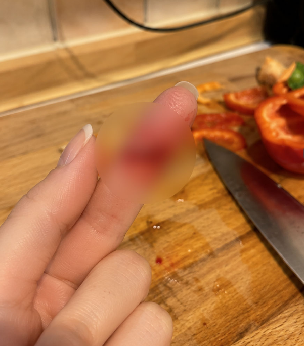 칼에 손가락 깊게 베였을때 (손가락봉합수술)