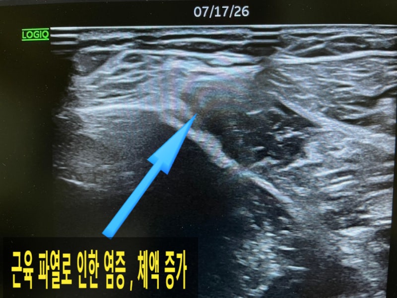 #1. 비복근 내측두 근육 파열, Tennis Leg 테니스 렉 Gr1-2 종아리 근육 파열, 부분 파열 초음파 설....