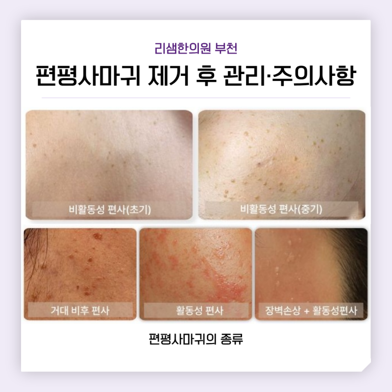 부천 편평사마귀 무제한 제거 후 관리·주의사항까지, 대표원장이 알려드립니다
