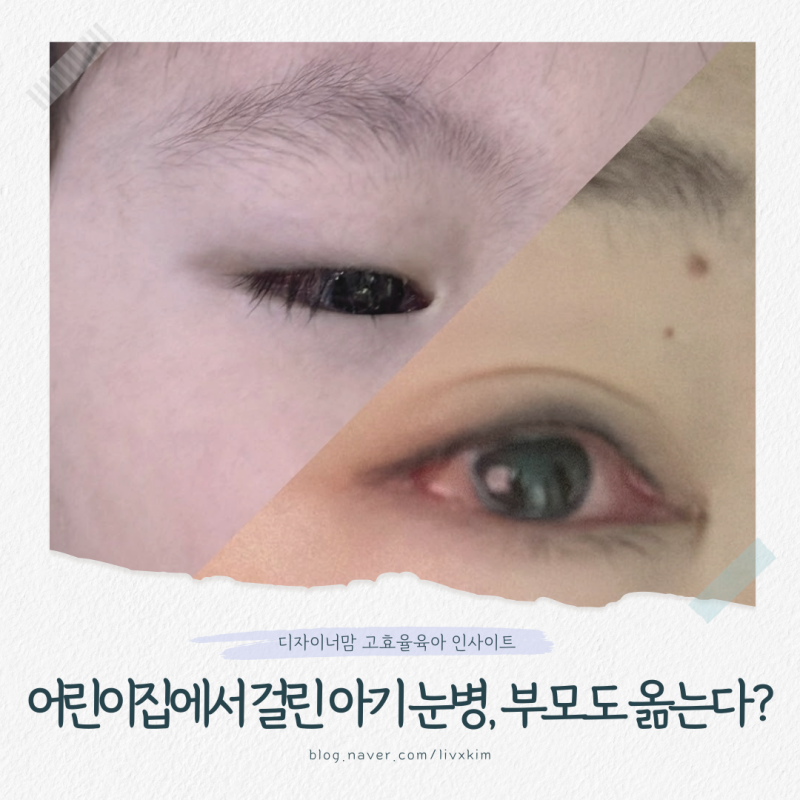 아기 유행성 결막염 눈병이 엄마도 옮는다? 주의사항 대처법과 예방 수칙!